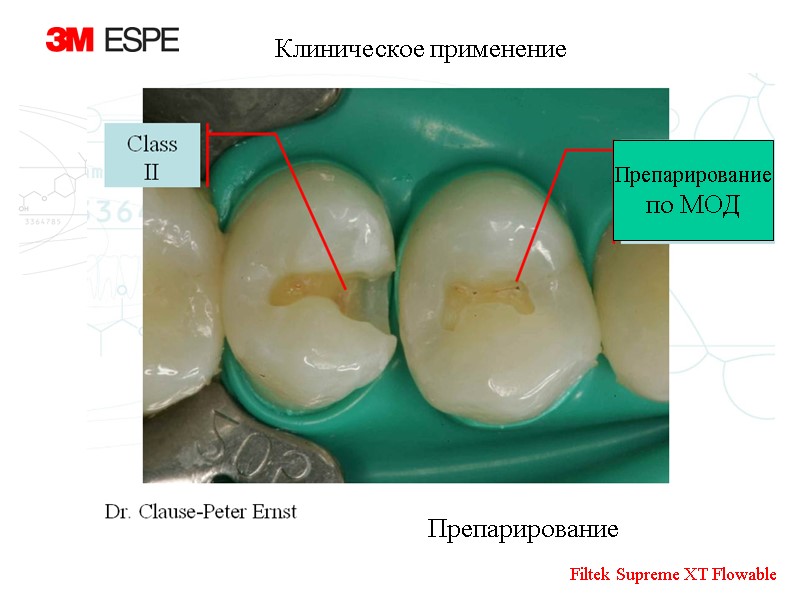 Препарирование по МОД Препарирование Клиническое применение